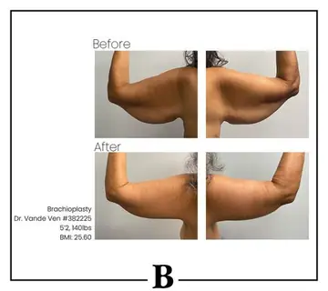 Before and after: Arm Lift, Dr. Heather Vande Ven