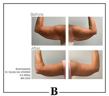 Before and after: Arm Lift, Dr. Heather Vande Ven