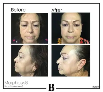 Before and after: Morpheus8