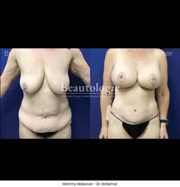 Before and after: Mommy Makeover, Dr. Thomas McNemar