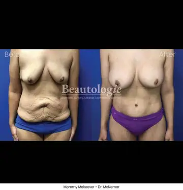 Before and after: Mommy Makeover, Dr. Thomas McNemar