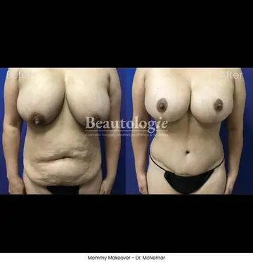 Before and after: Mommy Makeover, Dr. Thomas McNemar