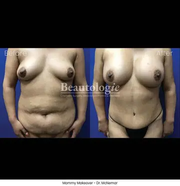 Before and after: Mommy Makeover, Dr. Thomas McNemar