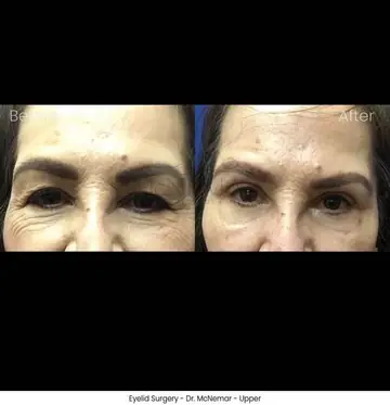 Before and after: Eyelid Surgery, Dr. Thomas McNemar