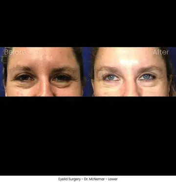 Before and after: Eyelid Surgery, Dr. Thomas McNemar