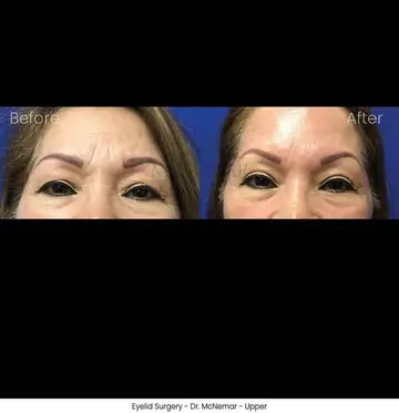 Before and after: Eyelid Surgery, Dr. Thomas McNemar