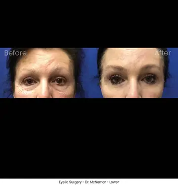 Before and after: Eyelid Surgery, Dr. Thomas McNemar