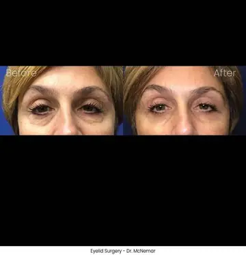 Before and after: Eyelid Surgery, Dr. Thomas McNemar