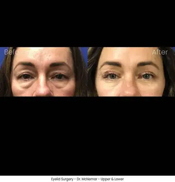 Before and after: Eyelid Surgery, Dr. Thomas McNemar