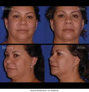 Before and after: Buccal Pad Removal, Dr. Thomas McNemar