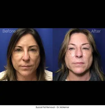 Before and after: Buccal Pad Removal, Dr. Thomas McNemar