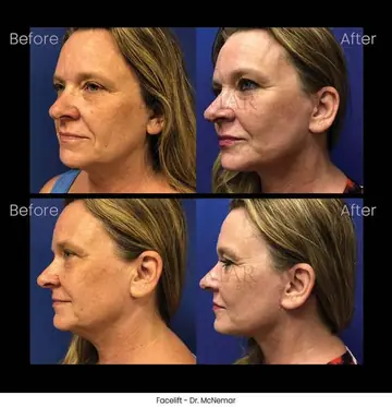 Before and after: Facelift, Dr. Thomas McNemar