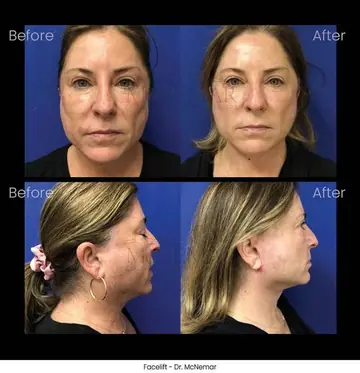 Before and after: Facelift, Dr. Thomas McNemar