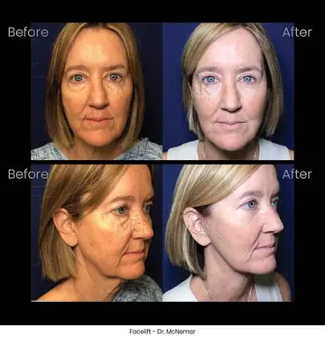 Before and after: Facelift, Dr. Thomas McNemar