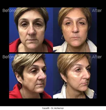 Before and after: Facelift, Dr. Thomas McNemar