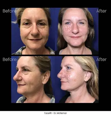Before and after: Facelift, Dr. Thomas McNemar