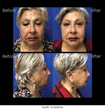 Before and after: Facelift, Dr. Thomas McNemar