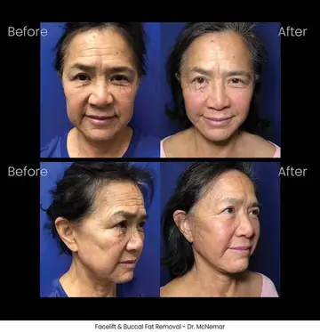 Before and after: Facelift, Dr. Thomas McNemar
