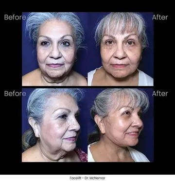Before and after: Facelift, Dr. Thomas McNemar