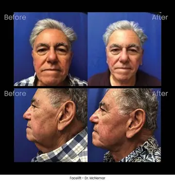 Before and after: Facelift Surgery for Men, Dr. Thomas McNemar