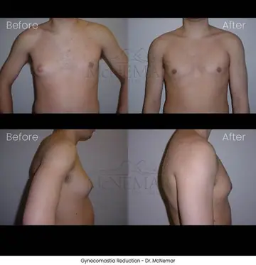 Before and after: Gynecomastia, Dr. Thomas McNemar