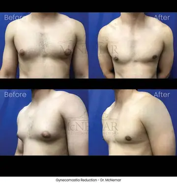 Before and after: Gynecomastia, Dr. Thomas McNemar