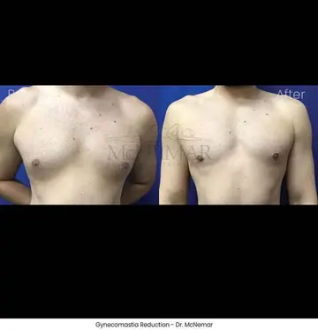 Before and after: Gynecomastia, Dr. Thomas McNemar