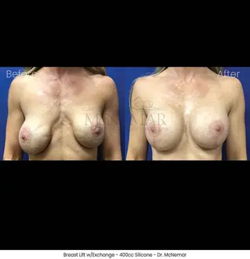 Before and after: Breast Lift, Dr. Thomas McNemar