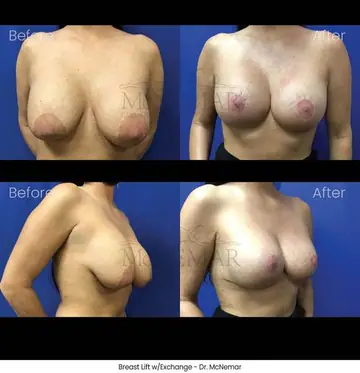 Before and after: Breast Lift, Dr. Thomas McNemar
