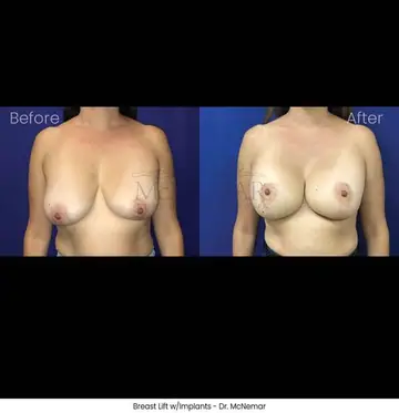 Before and after: Breast Lift, Dr. Thomas McNemar