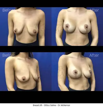 Before and after: Breast Lift, Dr. Thomas McNemar