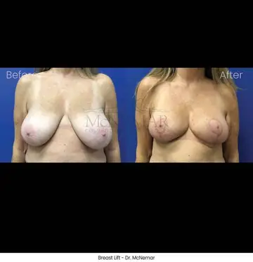Before and after: Breast Lift, Dr. Thomas McNemar