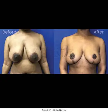 Before and after: Breast Lift, Dr. Thomas McNemar