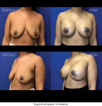 Before and after: Breast Lift, Dr. Thomas McNemar