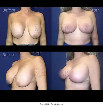 Before and after: Breast Lift, Dr. Thomas McNemar