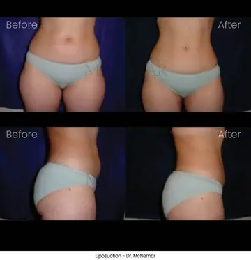 Before and after: Liposuction, Dr. Thomas McNemar
