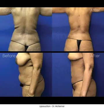 Before and after: Liposuction, Dr. Thomas McNemar