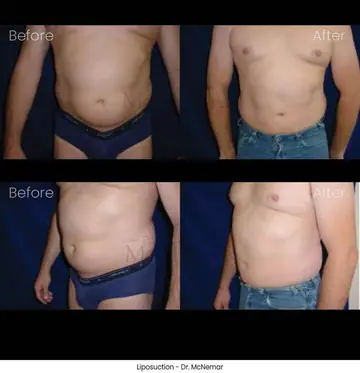 Before and after: Liposuction for Men, Dr. Thomas McNemar