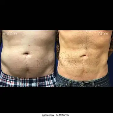 Before and after: Liposuction for Men, Dr. Thomas McNemar