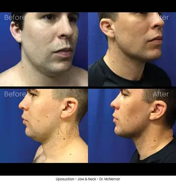 Before and after: Liposuction for Men, Dr. Thomas McNemar