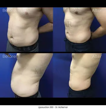 Before and after: Liposuction for Men, Dr. Thomas McNemar