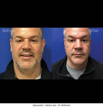 Before and after: Liposuction for Men, Dr. Thomas McNemar