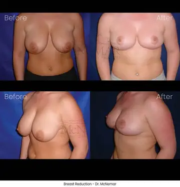 Before and after: Breast Reduction, Dr. Thomas McNemar