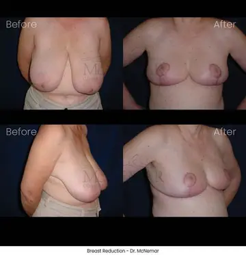 Before and after: Breast Reduction, Dr. Thomas McNemar