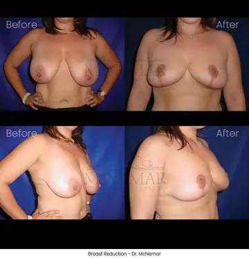 Before and after: Breast Reduction, Dr. Thomas McNemar