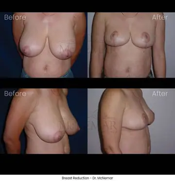 Before and after: Breast Reduction, Dr. Thomas McNemar