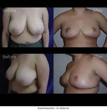 Before and after: Breast Reduction, Dr. Thomas McNemar