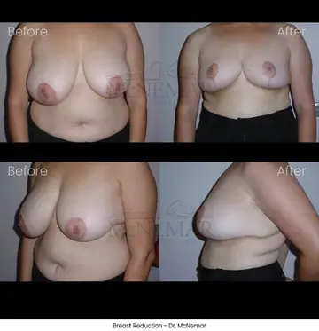 Before and after: Breast Reduction, Dr. Thomas McNemar