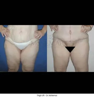 Before and after: Leg Lift, Dr. Thomas McNemar