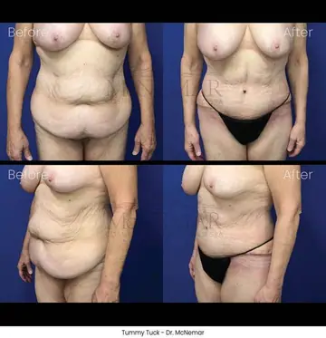 Before and after: Tummy Tuck, Dr. Thomas McNemar
